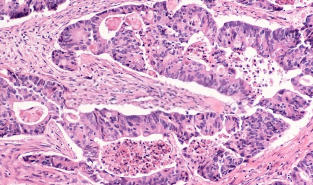 Bowel Cancer Screening