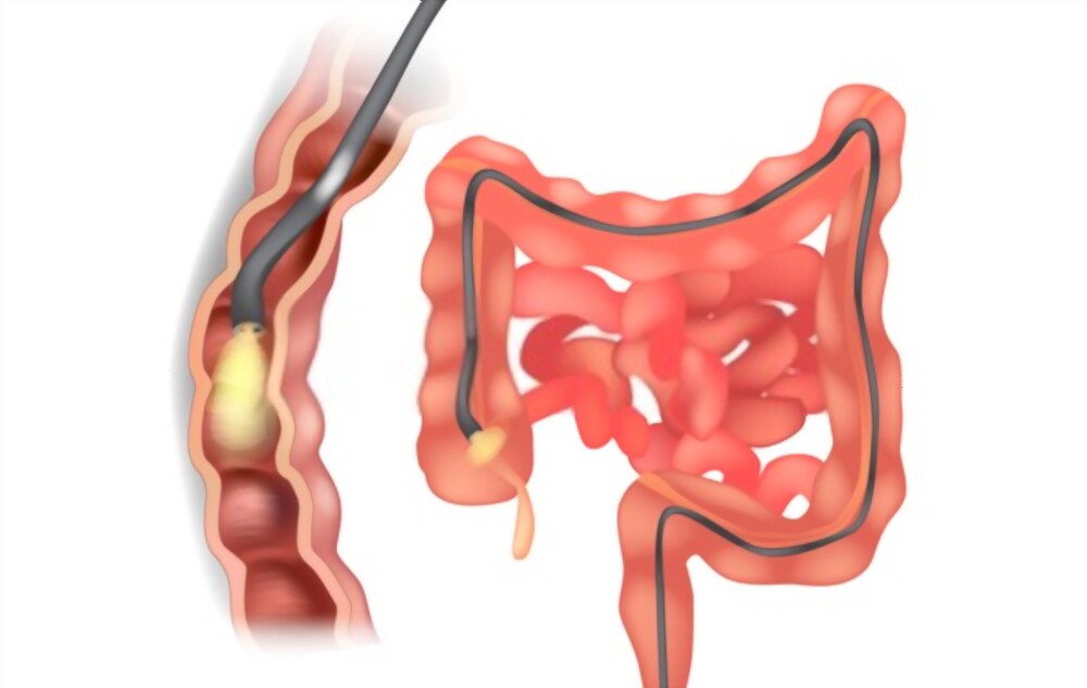 Colonoscopy Procedure