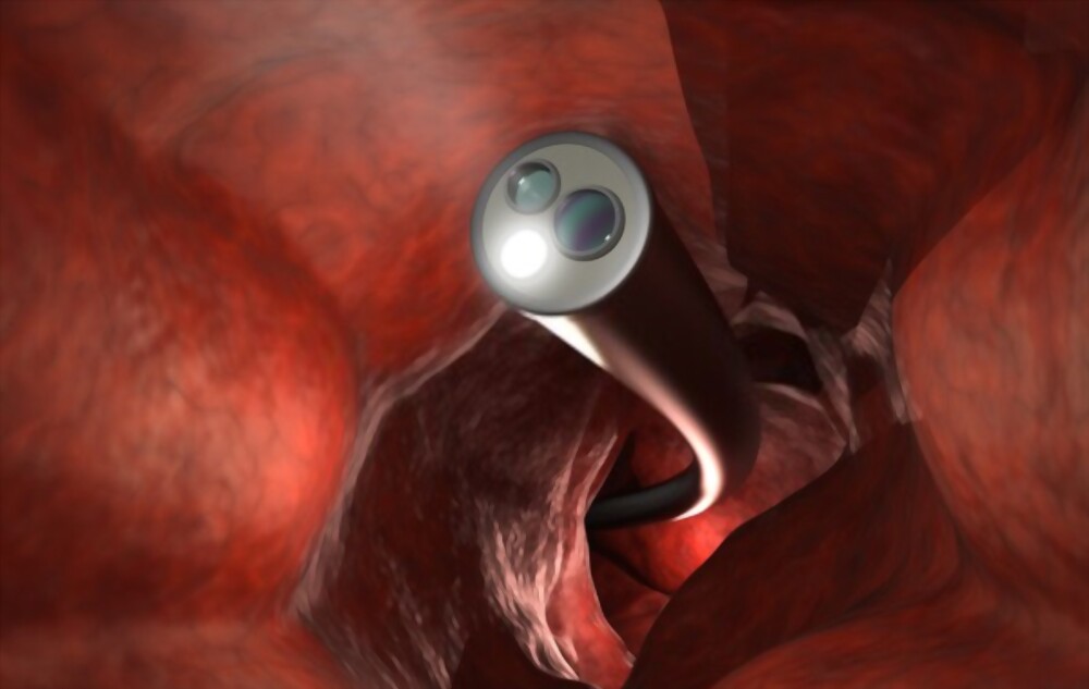 Get a Colonoscopy
