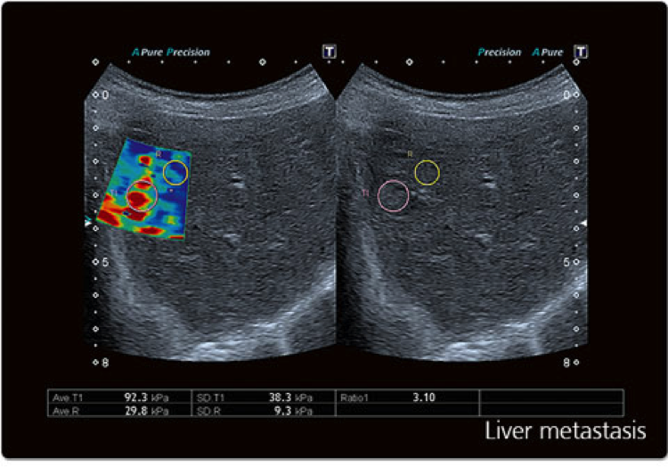 Liver ultrasound image metastasis